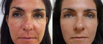 aculifting-francheville